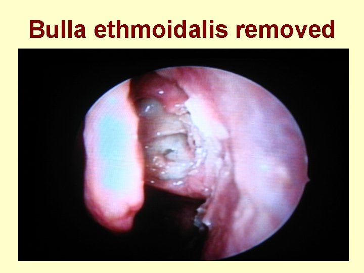 Bulla ethmoidalis removed 