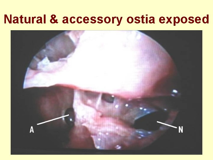 Natural & accessory ostia exposed 