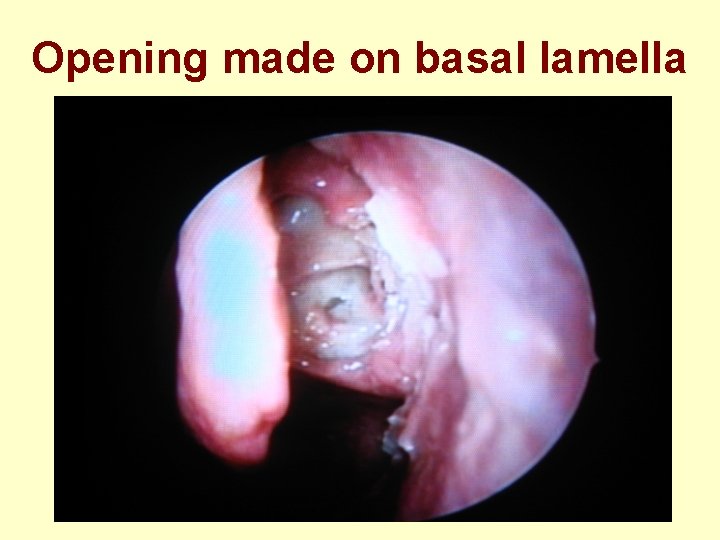 Opening made on basal lamella 