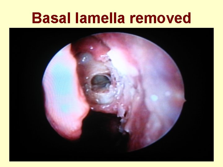 Basal lamella removed 