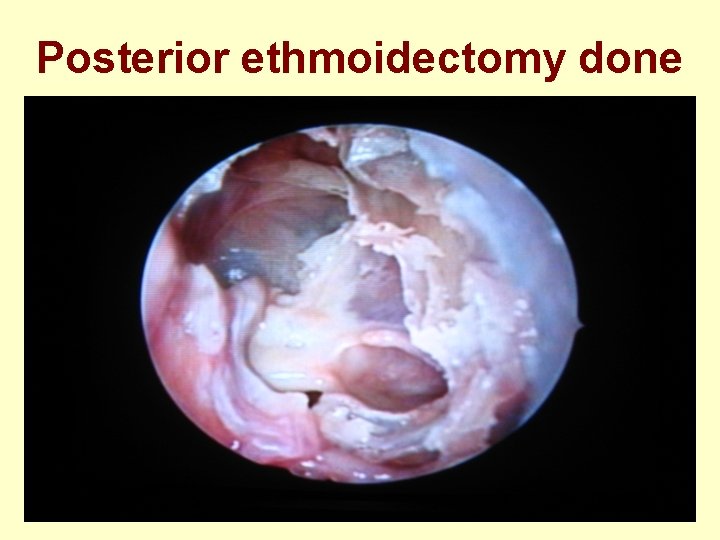 Posterior ethmoidectomy done 