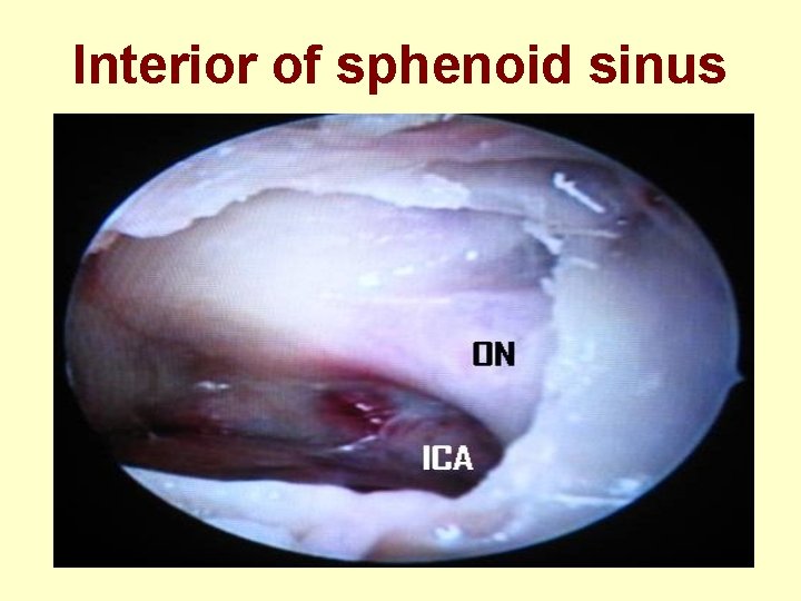 Interior of sphenoid sinus 
