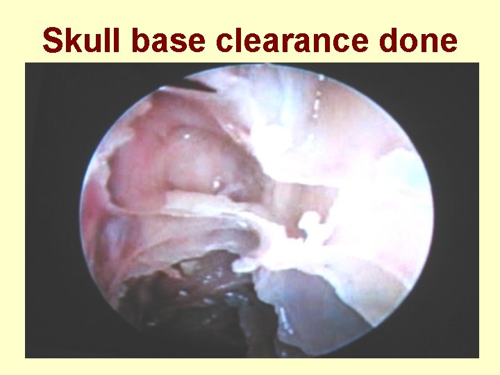 Skull base clearance done 