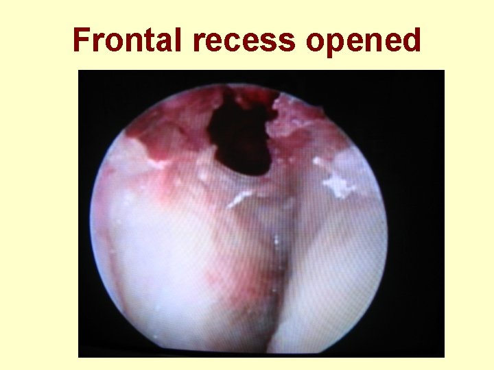 Frontal recess opened 