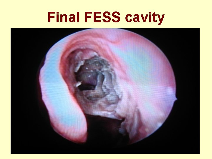 Final FESS cavity 