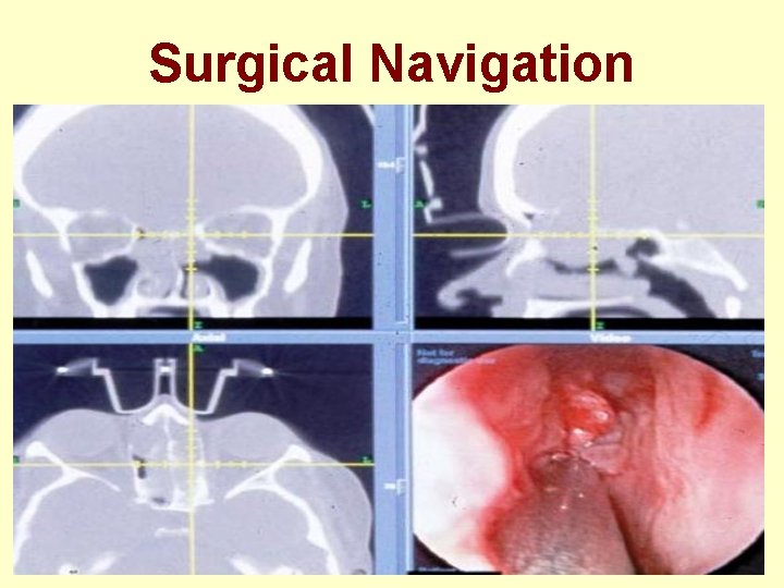 Surgical Navigation 