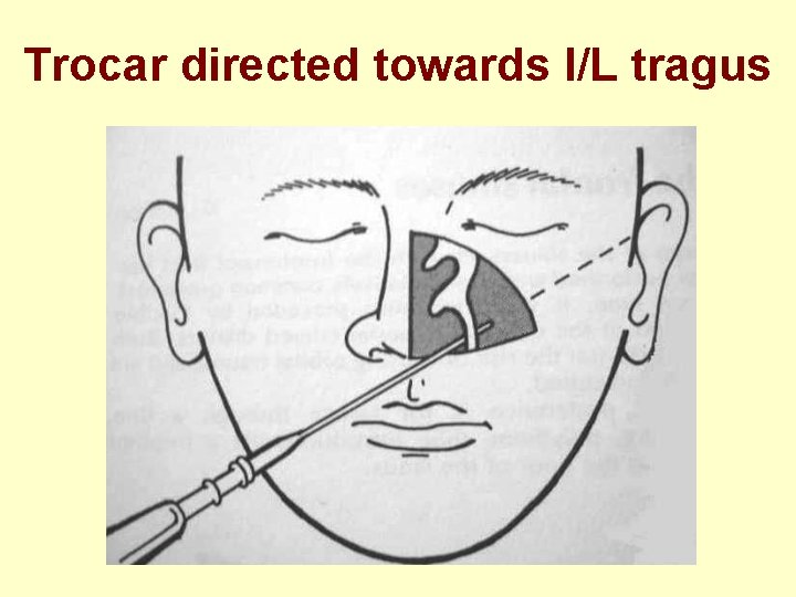 Trocar directed towards I/L tragus 