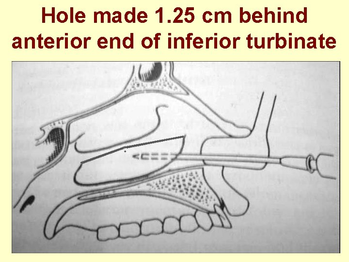 Hole made 1. 25 cm behind anterior end of inferior turbinate 