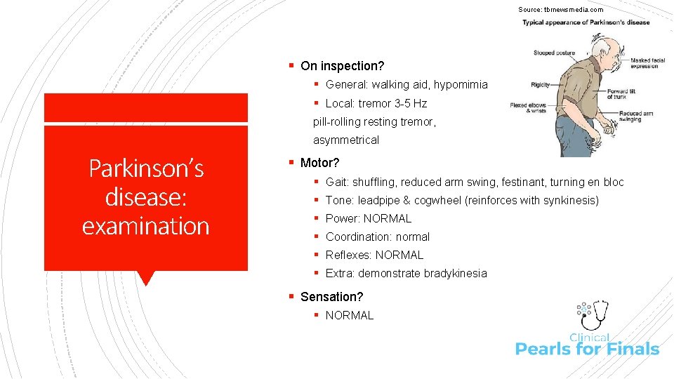 Source: tbrnewsmedia. com § On inspection? § General: walking aid, hypomimia § Local: tremor
