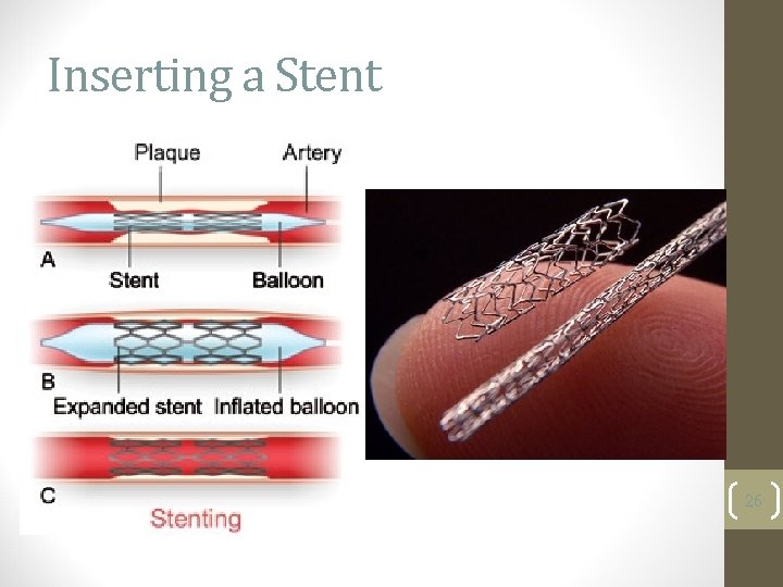 Inserting a Stent 26 