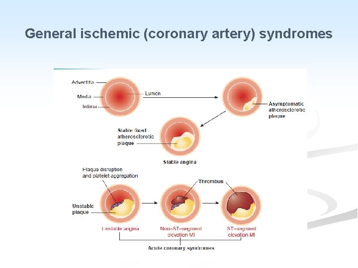 General ischemic (coronary artery) syndromes 