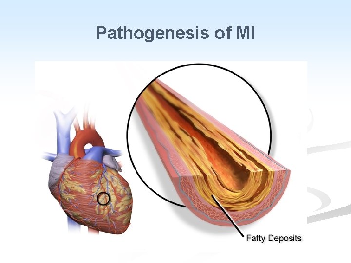 Pathogenesis of MI 