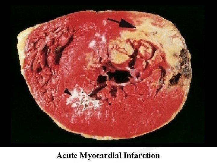 Acute Myocardial Infarction 