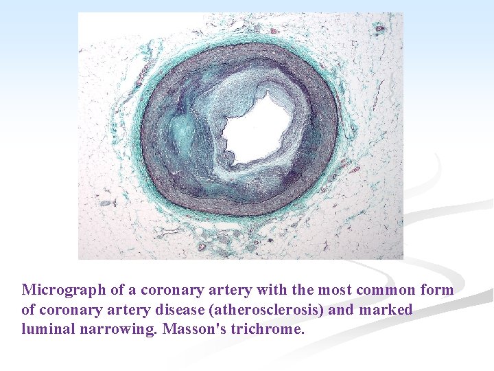 Micrograph of a coronary artery with the most common form of coronary artery disease