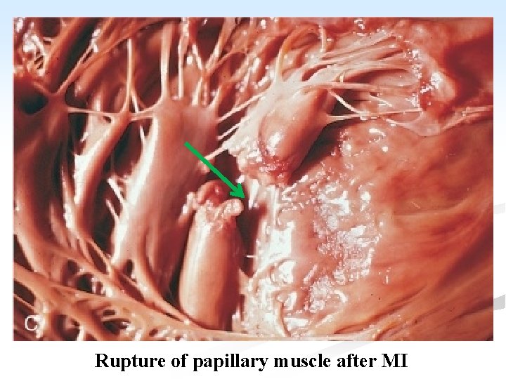 Rupture of papillary muscle after MI 