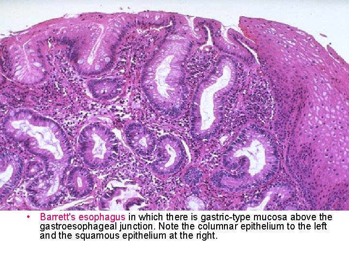  • Barrett's esophagus in which there is gastric-type mucosa above the gastroesophageal junction.