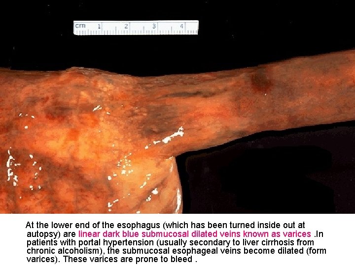 At the lower end of the esophagus (which has been turned inside out at