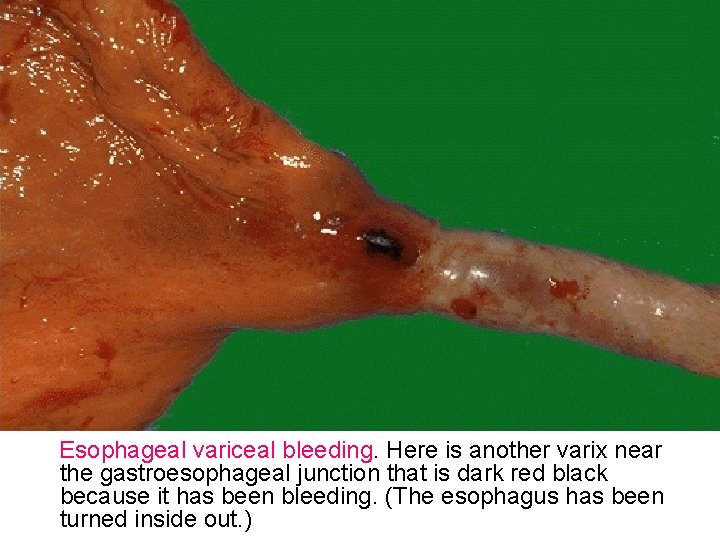 Esophageal variceal bleeding. Here is another varix near the gastroesophageal junction that is dark