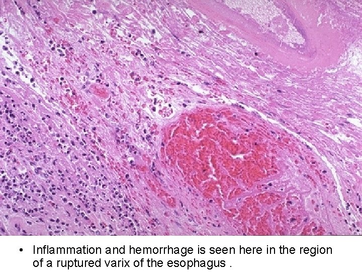  • Inflammation and hemorrhage is seen here in the region of a ruptured