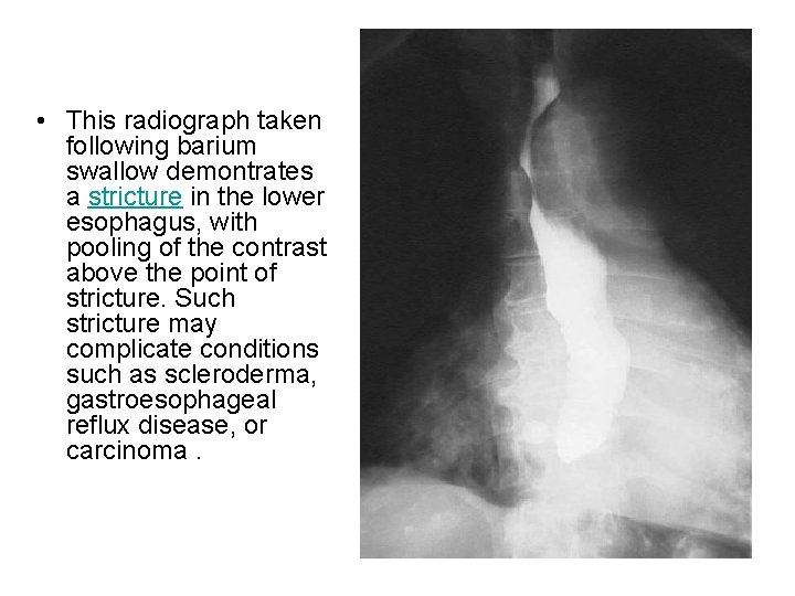  • This radiograph taken following barium swallow demontrates a stricture in the lower