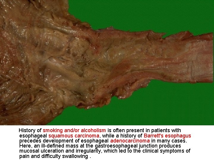 History of smoking and/or alcoholism is often present in patients with esophageal squamous carcinoma,
