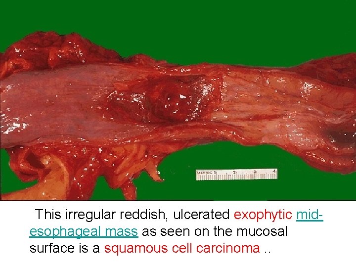 This irregular reddish, ulcerated exophytic midesophageal mass as seen on the mucosal surface is
