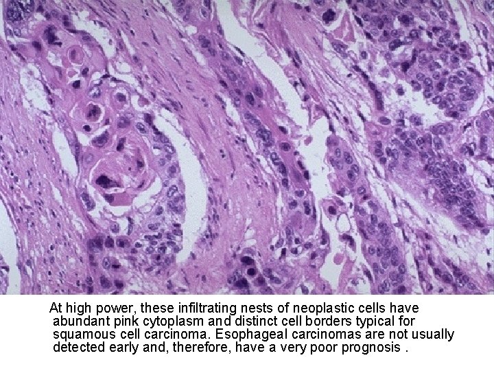 At high power, these infiltrating nests of neoplastic cells have abundant pink cytoplasm and