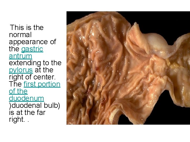 This is the normal appearance of the gastric antrum extending to the pylorus at