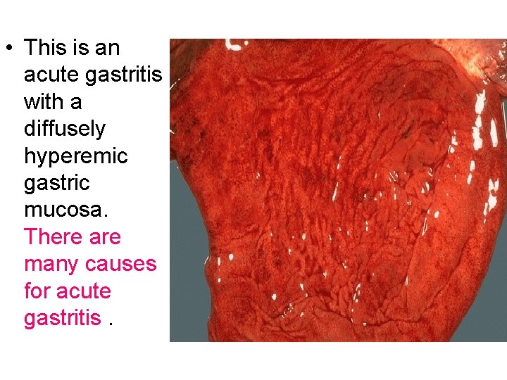  • This is an acute gastritis with a diffusely hyperemic gastric mucosa. There