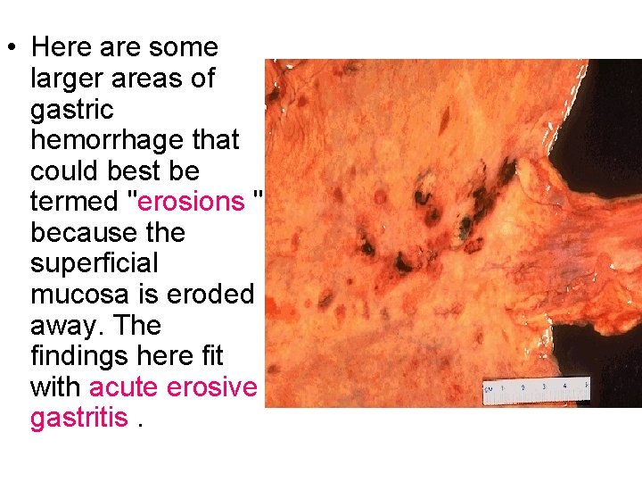  • Here are some larger areas of gastric hemorrhage that could best be