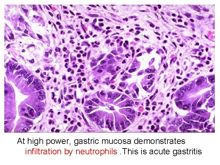 At high power, gastric mucosa demonstrates infiltration by neutrophils. This is acute gastritis 