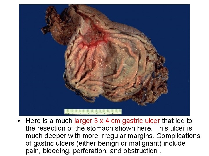  • Here is a much larger 3 x 4 cm gastric ulcer that