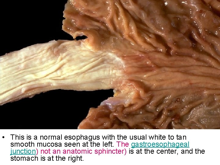  • This is a normal esophagus with the usual white to tan smooth