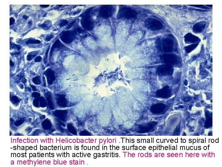 Infection with Helicobacter pylori. This small curved to spiral rod -shaped bacterium is found