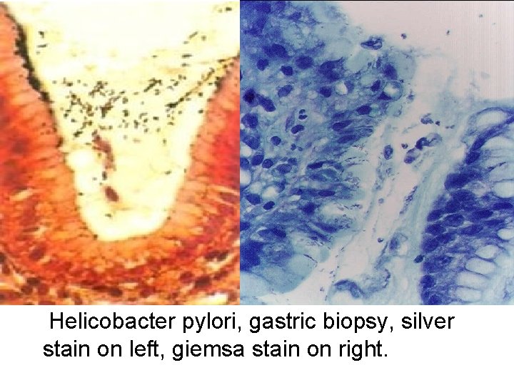 Helicobacter pylori, gastric biopsy, silver stain on left, giemsa stain on right. 