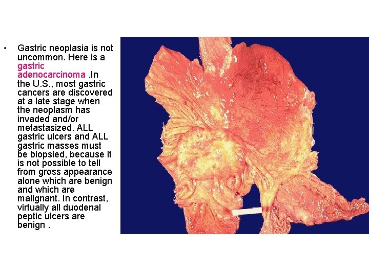  • Gastric neoplasia is not uncommon. Here is a gastric adenocarcinoma. In the