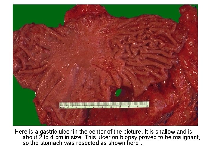 Here is a gastric ulcer in the center of the picture. It is shallow