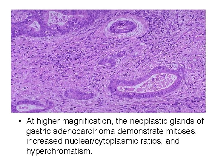  • At higher magnification, the neoplastic glands of gastric adenocarcinoma demonstrate mitoses, increased
