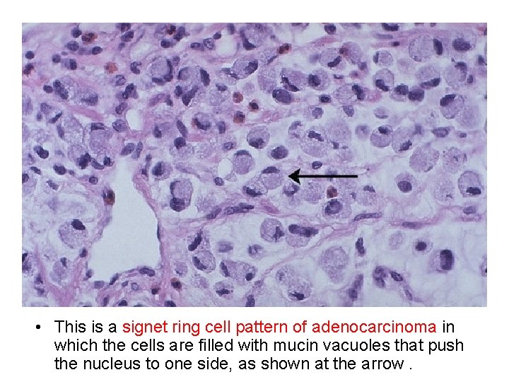  • This is a signet ring cell pattern of adenocarcinoma in which the