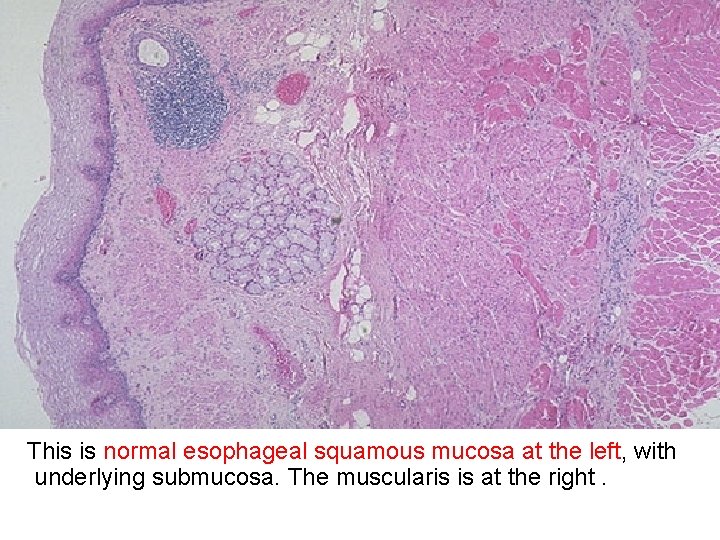 This is normal esophageal squamous mucosa at the left, with underlying submucosa. The muscularis