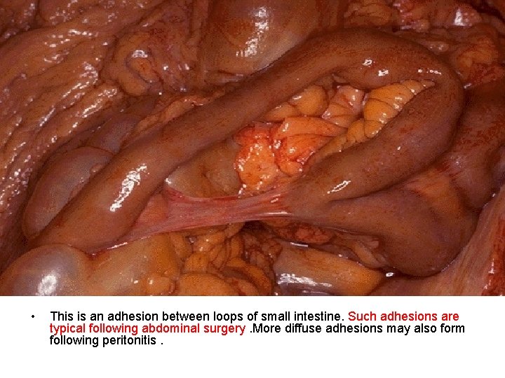  • This is an adhesion between loops of small intestine. Such adhesions are