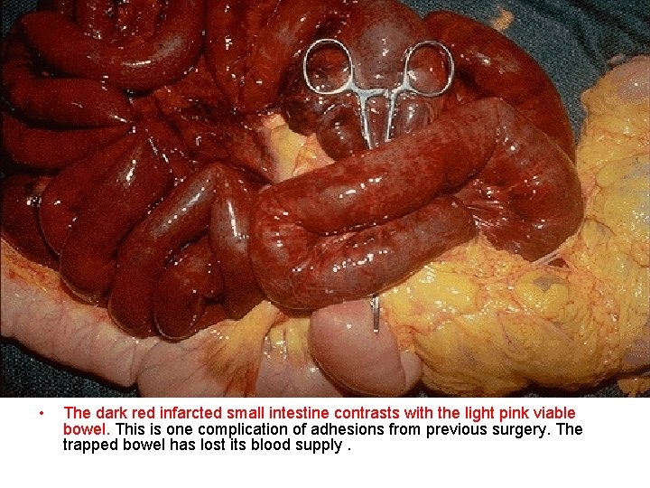  • The dark red infarcted small intestine contrasts with the light pink viable