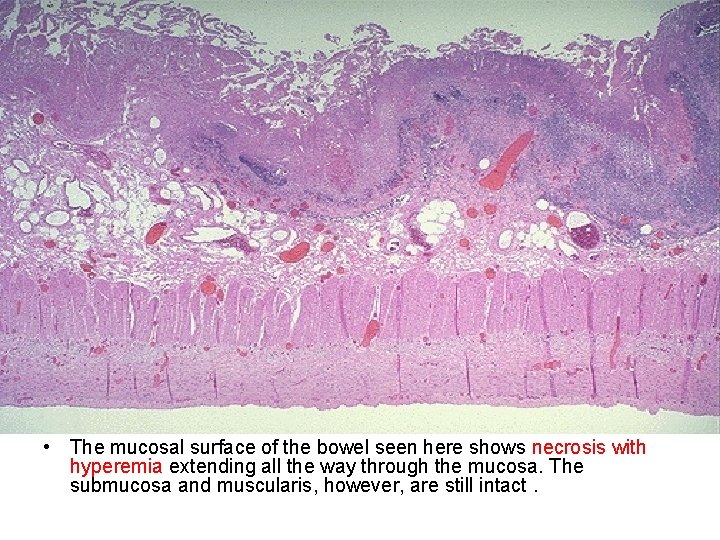  • The mucosal surface of the bowel seen here shows necrosis with hyperemia