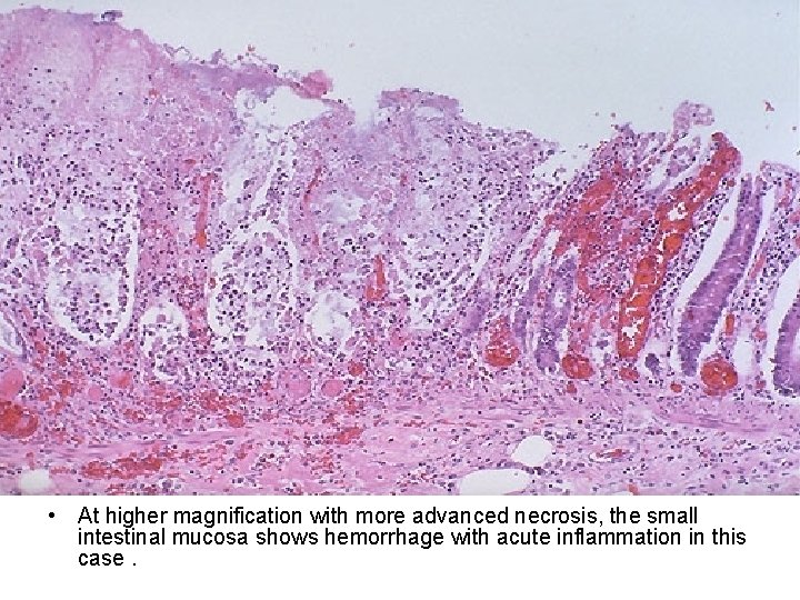  • At higher magnification with more advanced necrosis, the small intestinal mucosa shows