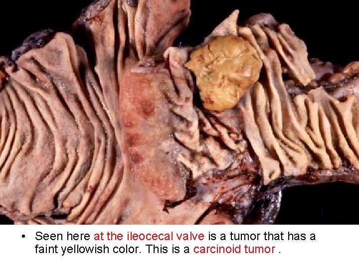  • Seen here at the ileocecal valve is a tumor that has a