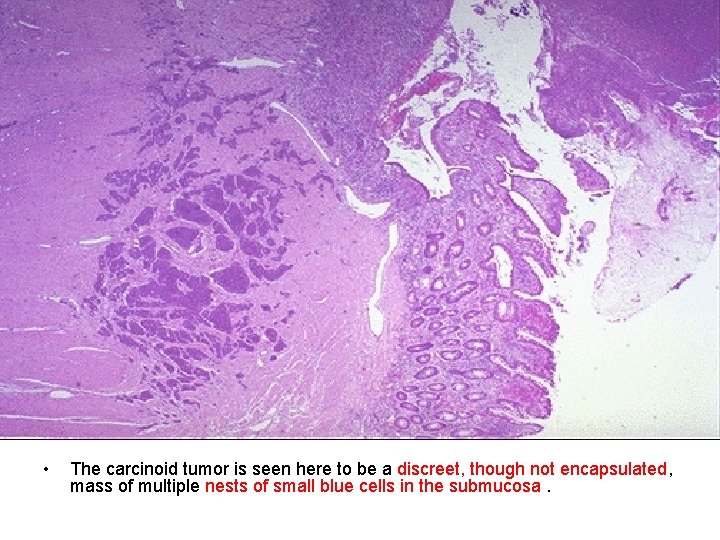  • The carcinoid tumor is seen here to be a discreet, though not
