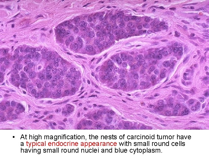  • At high magnification, the nests of carcinoid tumor have a typical endocrine