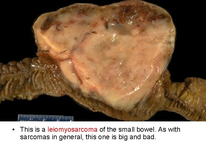  • This is a leiomyosarcoma of the small bowel. As with sarcomas in