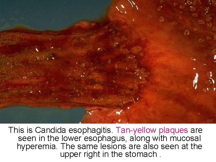 This is Candida esophagitis. Tan-yellow plaques are seen in the lower esophagus, along with