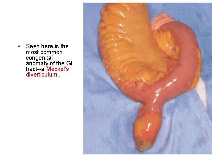  • Seen here is the most common congenital anomaly of the GI tract--a